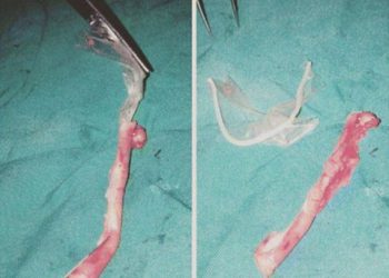 Unbelievable!! Condom Found Inside A Woman’s Appendix (Photos)