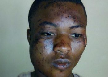 Injured Armed Robber Escapes From Hospital (Photo)